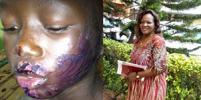 Woman who tortured stepson with hot iron, flees   