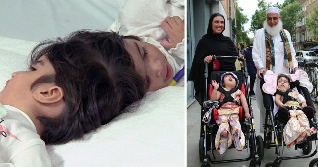 Doctors separate twins joined at the head after 50-hour surgery