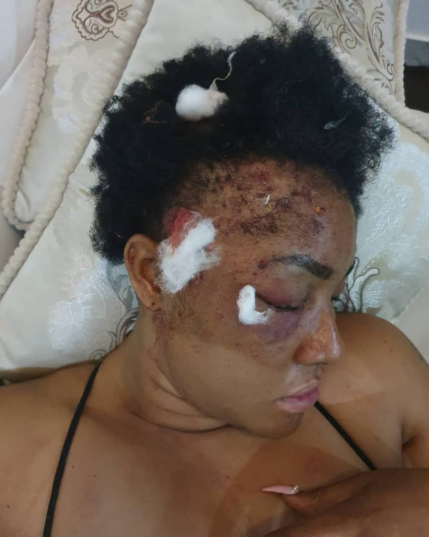 Anyone who says this is make up, I wish them same – Angela Okorie reacts to claims she made up attack, injury on her