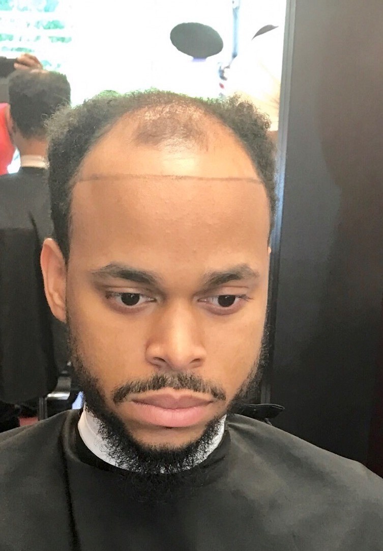 COVID-19: You may want to be careful if you are bald